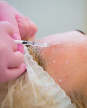 Acne Inject
