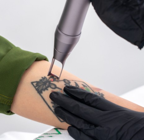 Laser Black Spot Removal (Tato / Bekas Luka)