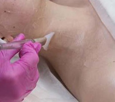Chemical Peeling Body Area - Leher