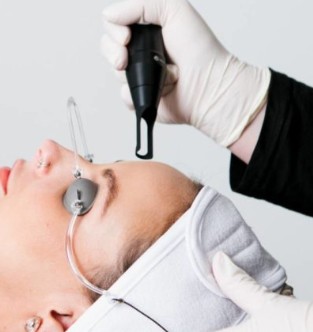 Facial Laser Acne Spot