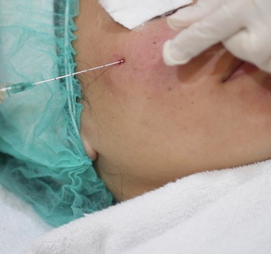 Subsisi With Serum