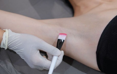 Chemical Peeling Body Area - Ketiak